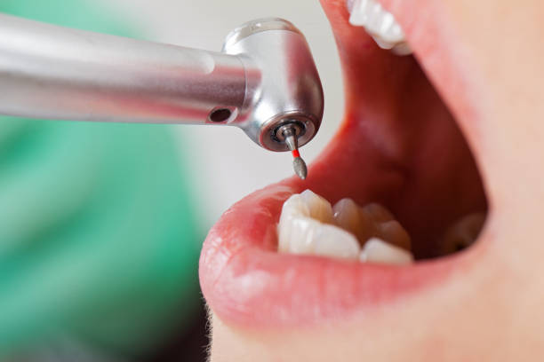 Best Emergency Wisdom Tooth Extraction in Hillsboro, MO